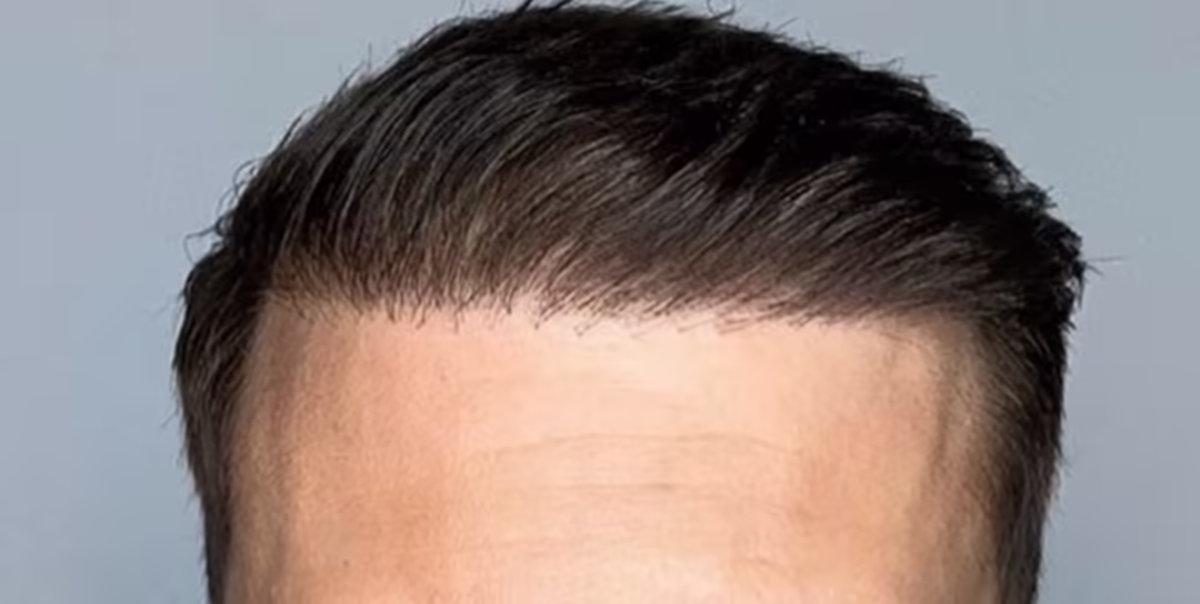 After — 6,500 grafts, Norwood 4: hair transplant before and after