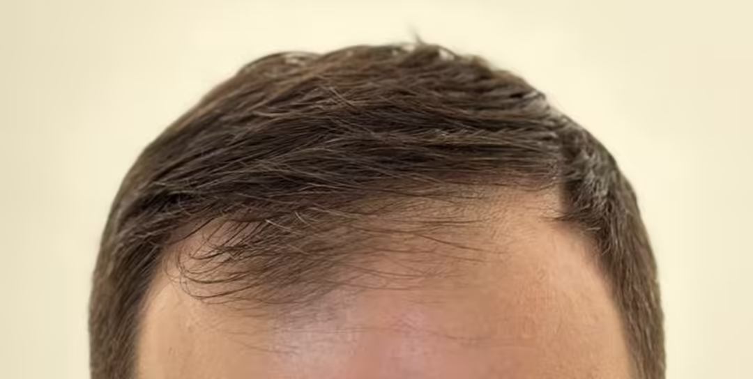 Before — 6,500 grafts, Norwood 4: hair transplant before and after