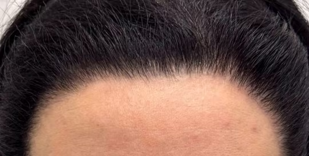 After — 500 grafts, Norwood 2: hair transplant before and after