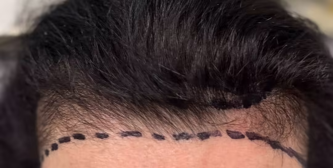 Before — 500 grafts, Norwood 2: hair transplant before and after