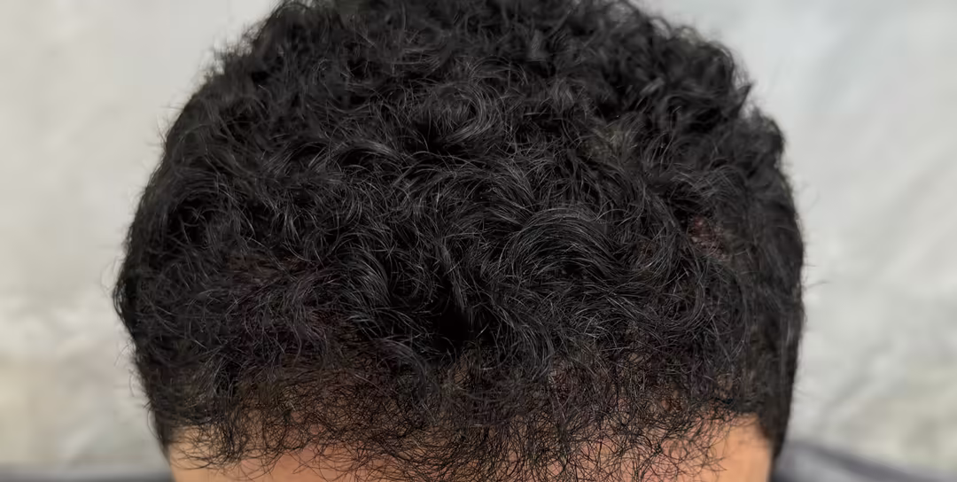 After — 6,000 grafts, Norwood 4: hair transplant before and after
