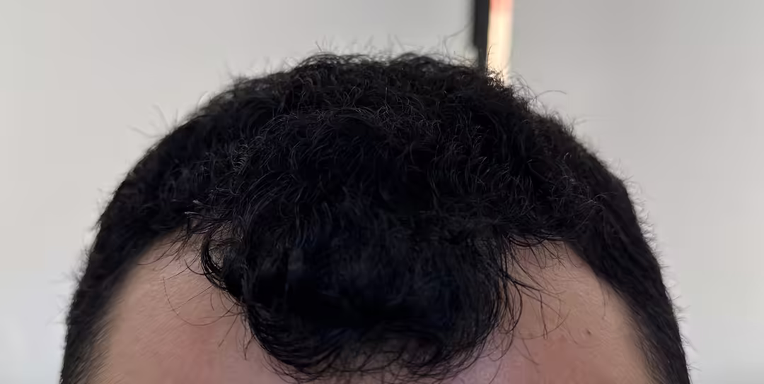 Before — 6,000 grafts, Norwood 4: hair transplant before and after