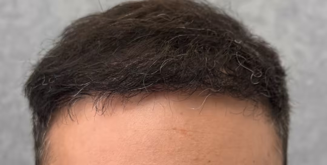 After — 6,850 grafts, Norwood 4: hair transplant before and after