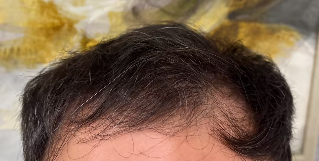 Before — 6,850 grafts, Norwood 4: hair transplant before and after