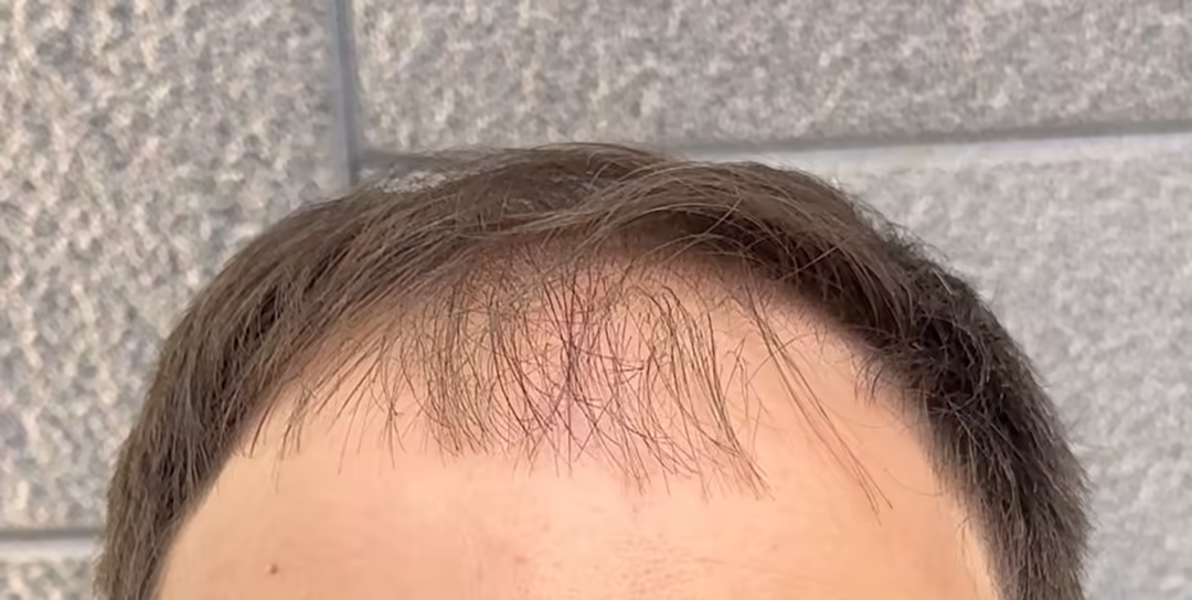 До — 5 551 графтов, Норвуд 3: пересадка волос до и после