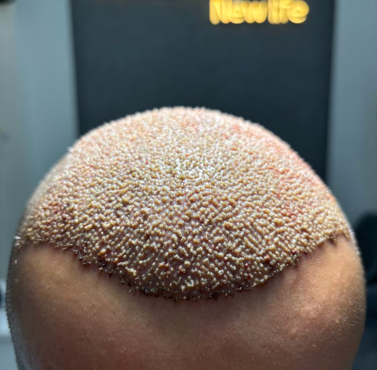 DHI procedure using the Choi implanter pen for direct hair implantation.