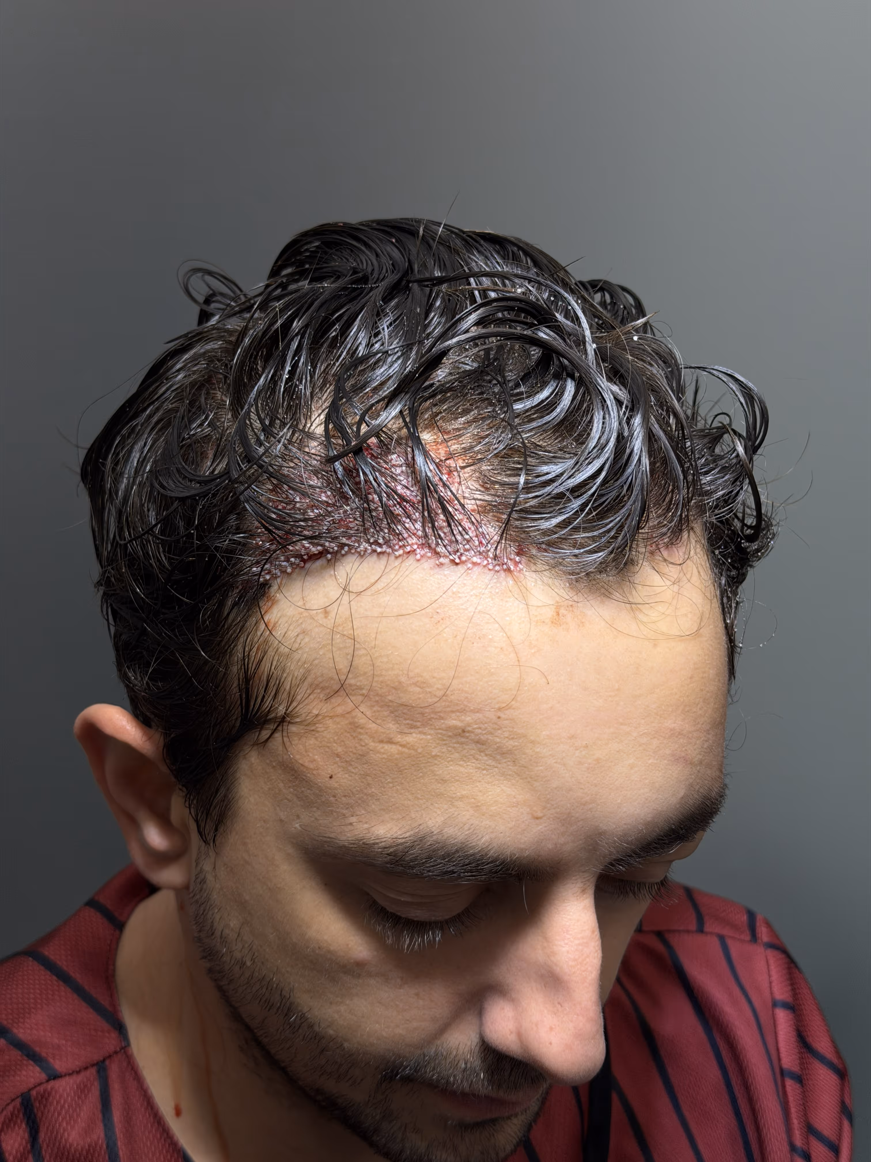 Long Hair FUE procedure preserving existing length.