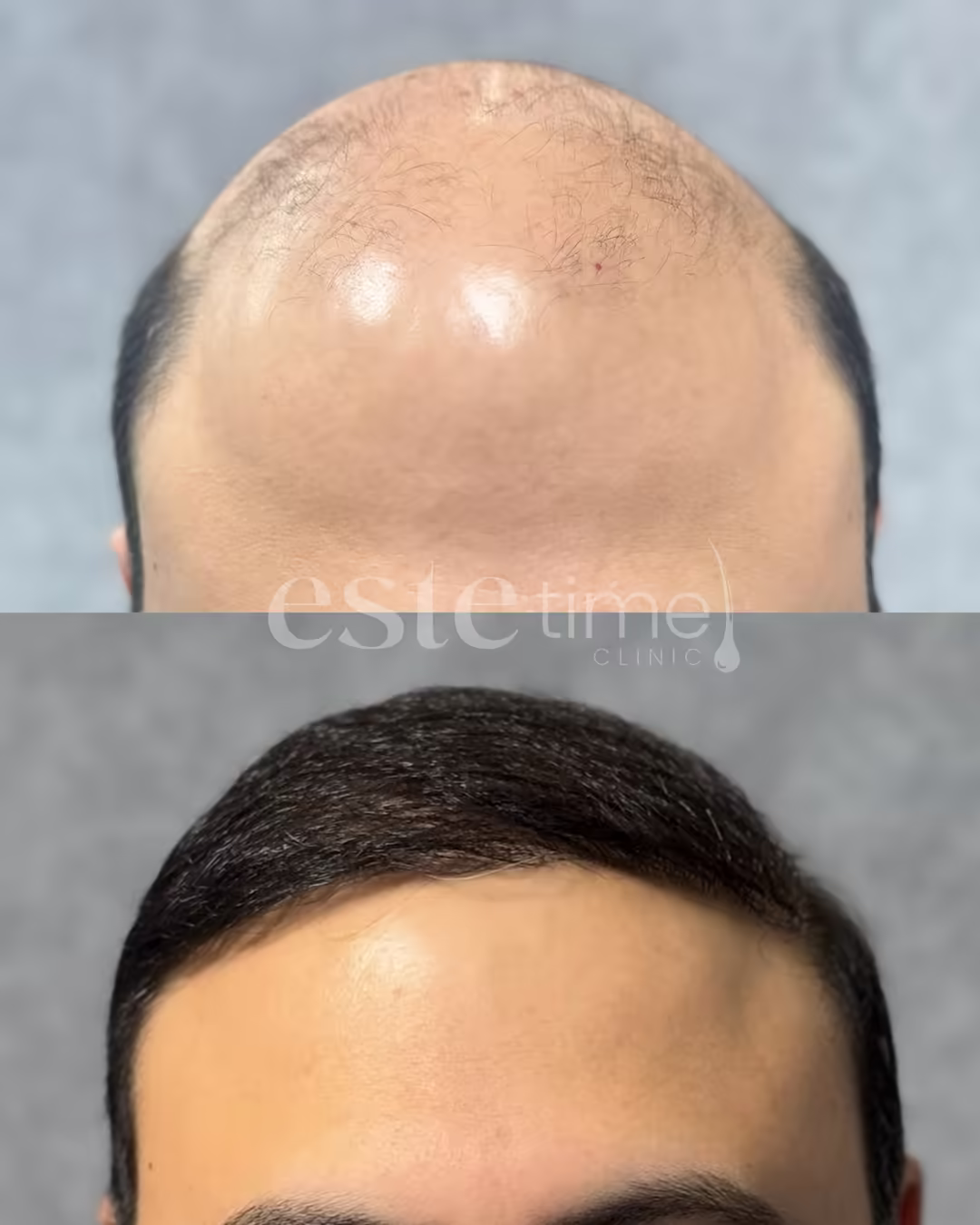 Hair transplant before and after result — FUE, 5781 grafts, NW6