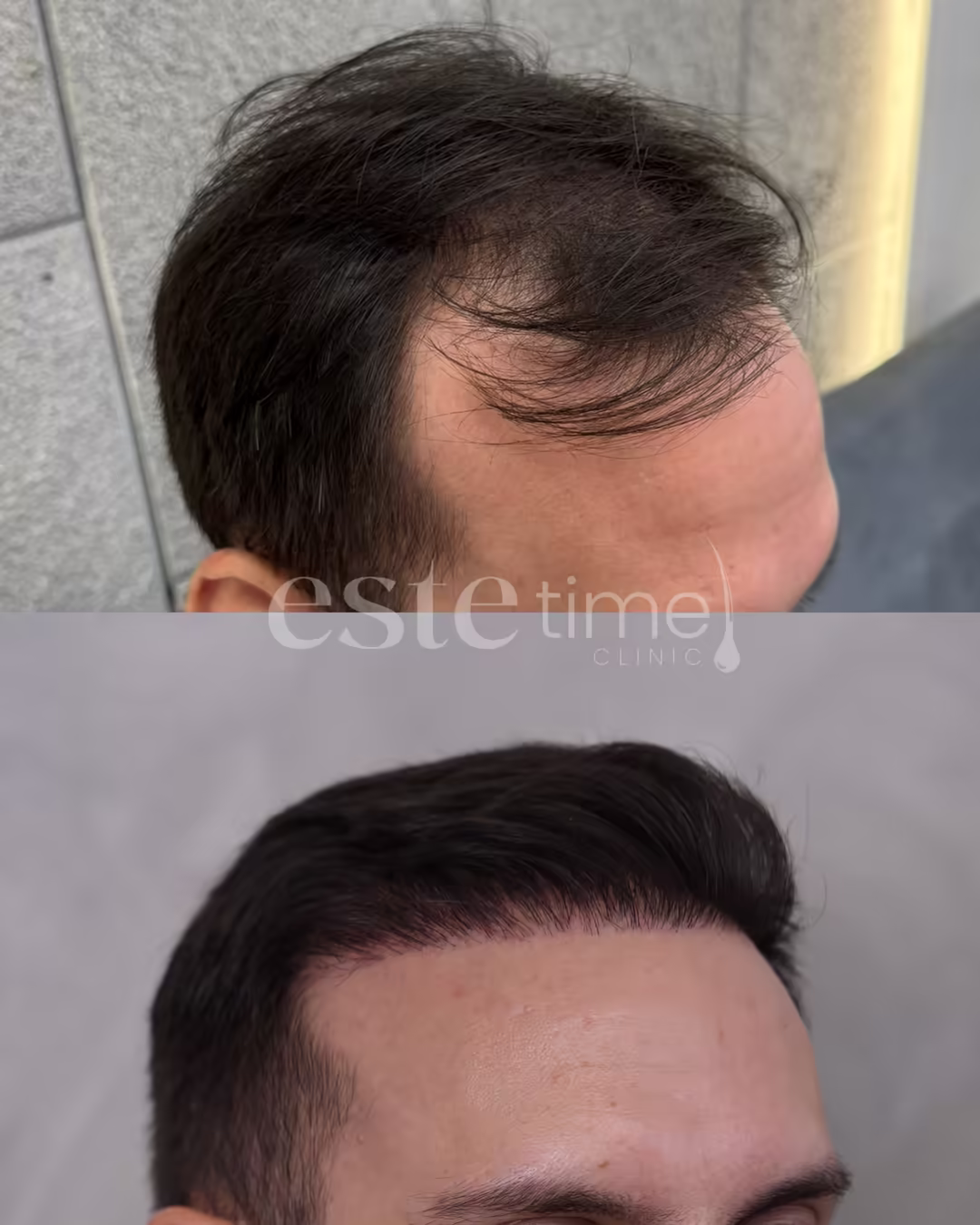 Hair transplant before and after result — FUE, 3850 grafts, NW4