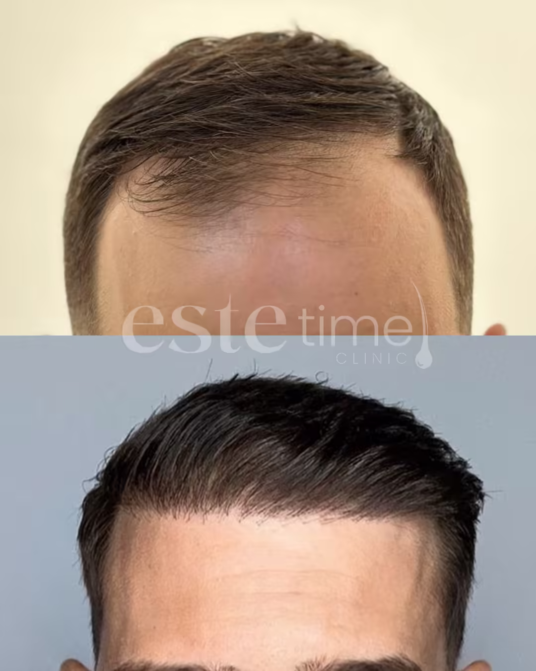 Hair transplant before and after result — FUE, 6500 grafts, NW4