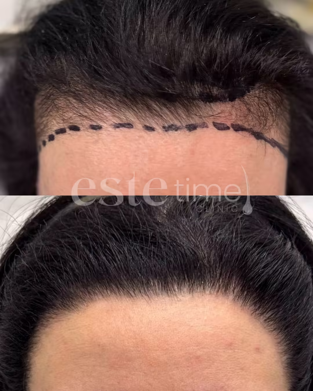 Hair transplant before and after result — FUE, 500 grafts, NW2