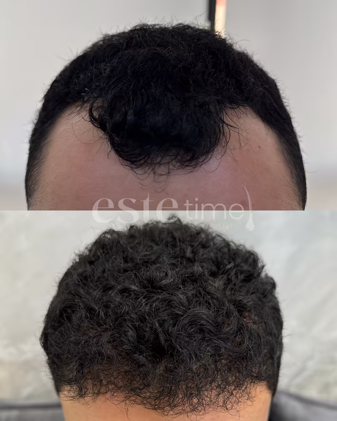 Hair transplant before and after result — FUE, 6000 grafts, NW4