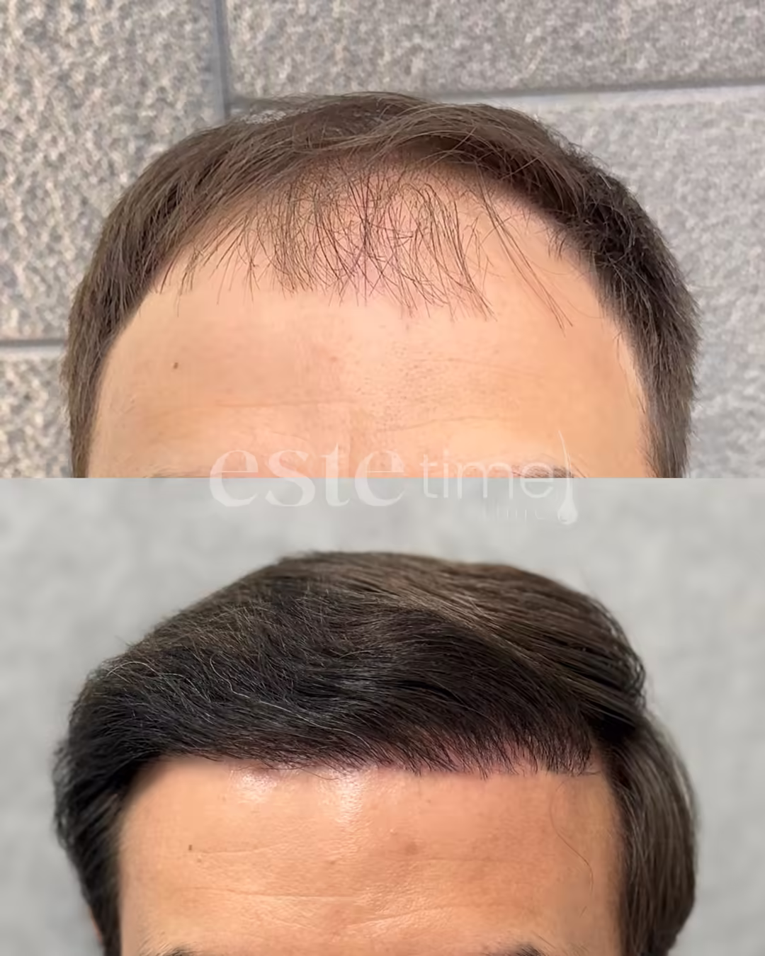 Hair transplant before and after result — FUE, 5551 grafts, NW3