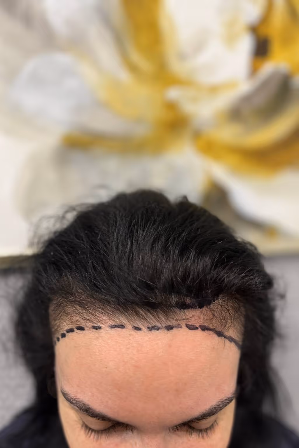 A woman consulting about female pattern hair loss and hair transplant candidacy at Estetime clinic in Yerevan, Armenia.