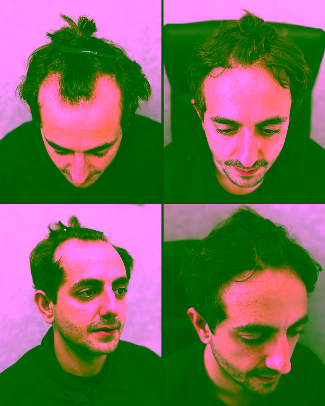 Estetime Long Hair FUE patient — before and after, front and side views, showing a restored hairline with the existing hair kept at full length.