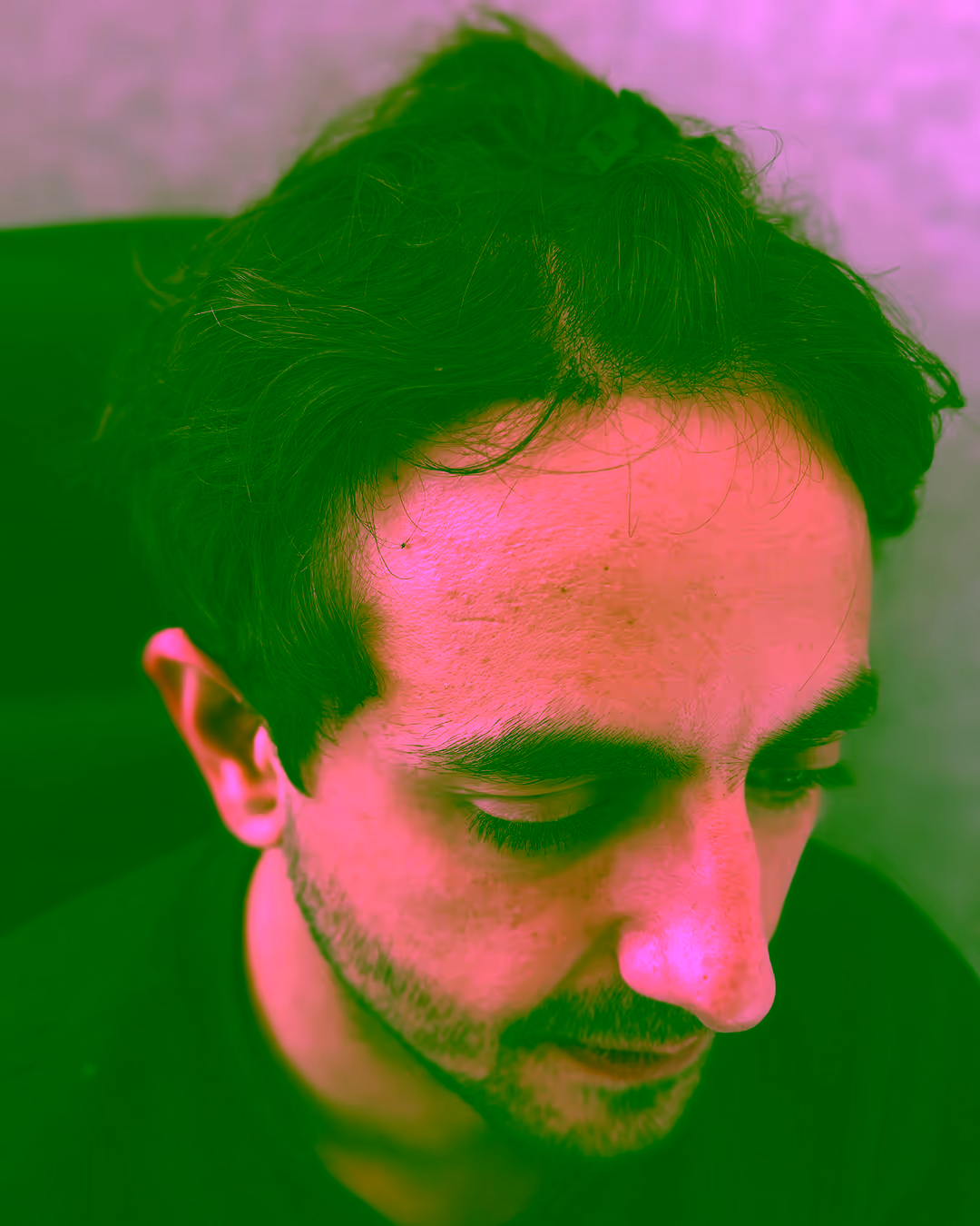 Estetime Long Hair FUE patient — a man with long hair and a restored frontal hairline, his donor area kept at full length.