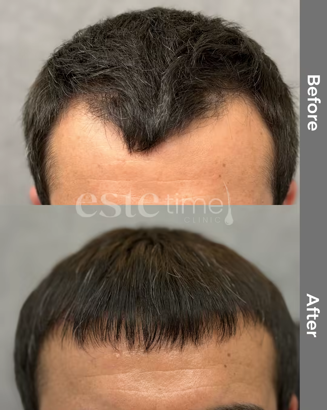 Hair transplant before and after result — LH FUE, 900 grafts, NW2