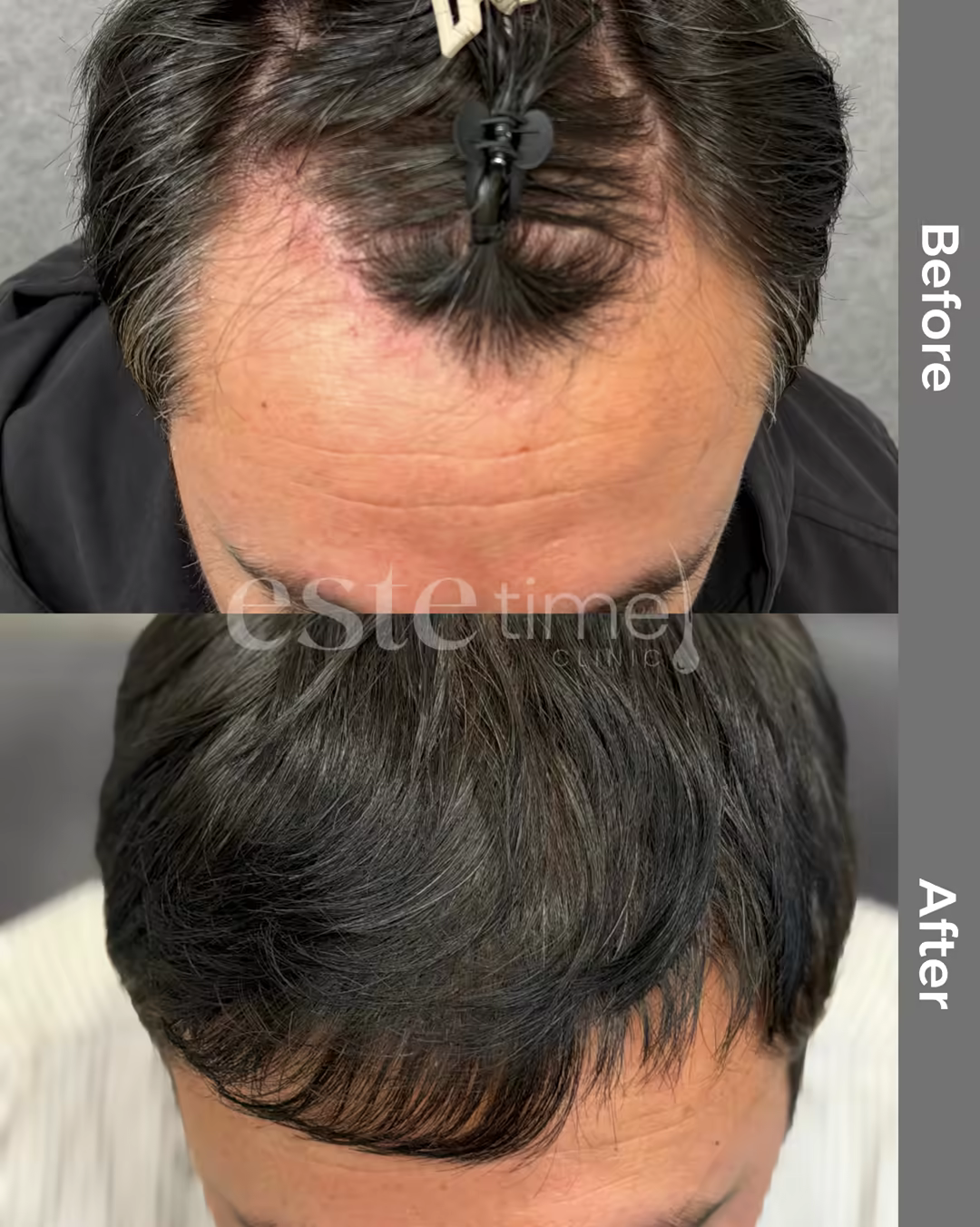 Hair transplant before and after result — LH FUE, 2000 grafts, NW2