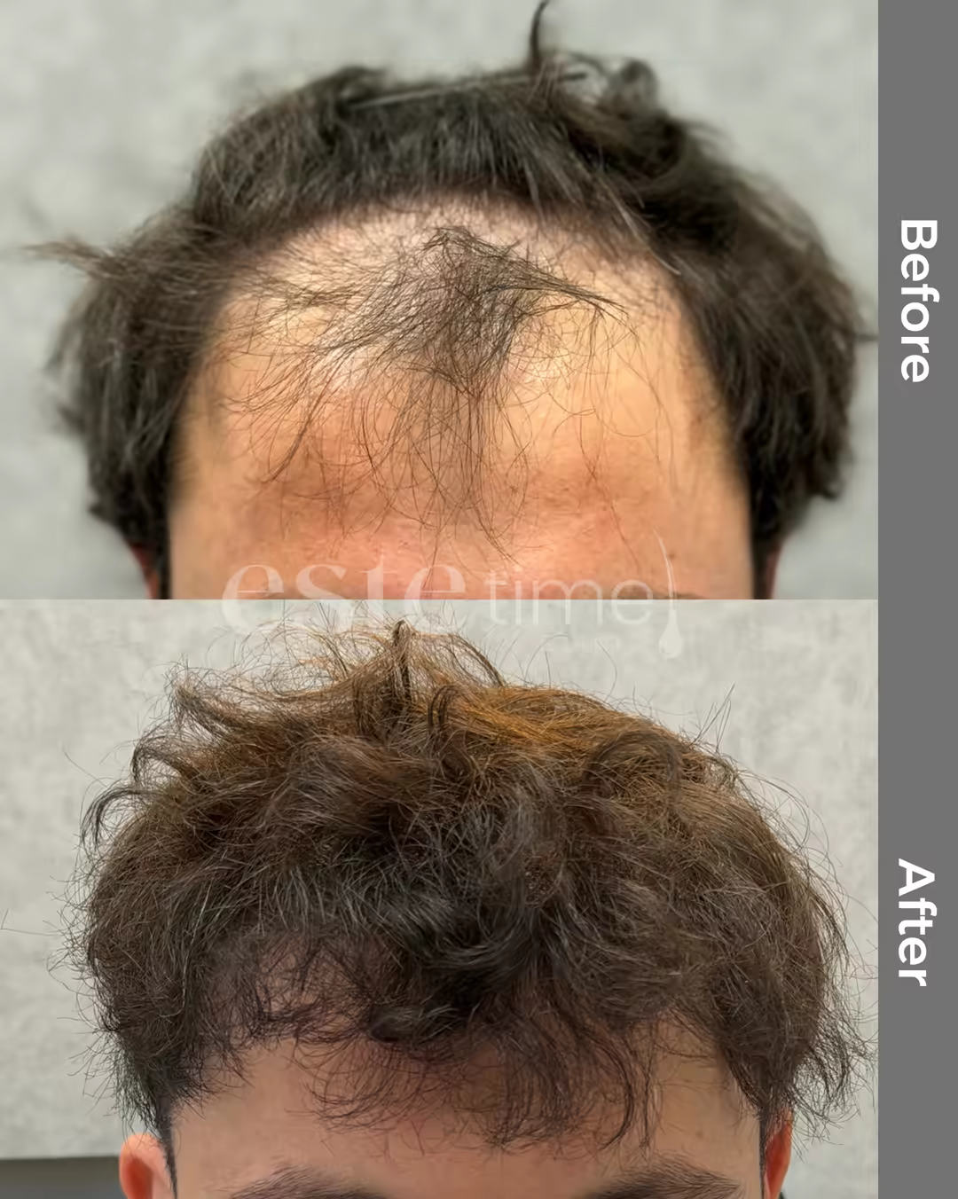 Hair transplant before and after result — LH FUE, 5000 grafts, NW3