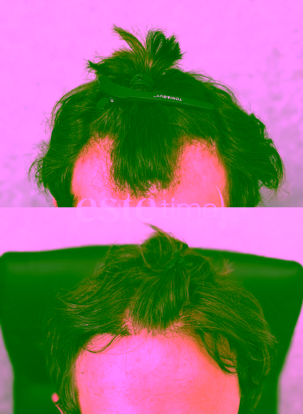 Hair transplant before and after result — LH FUE, 1500 grafts, NW2